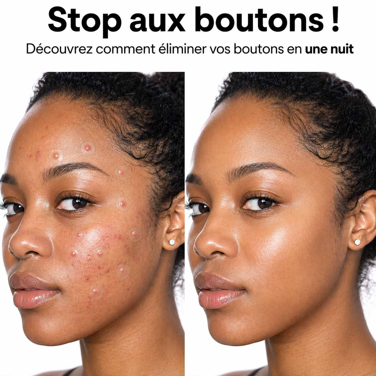 Patch Anti-Acné Invisible - Dites adieu à vos boutons