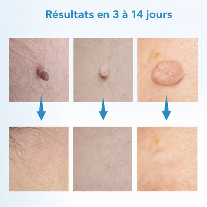 Kit Skin Tag – Éliminez les excroissances de peau à la maison