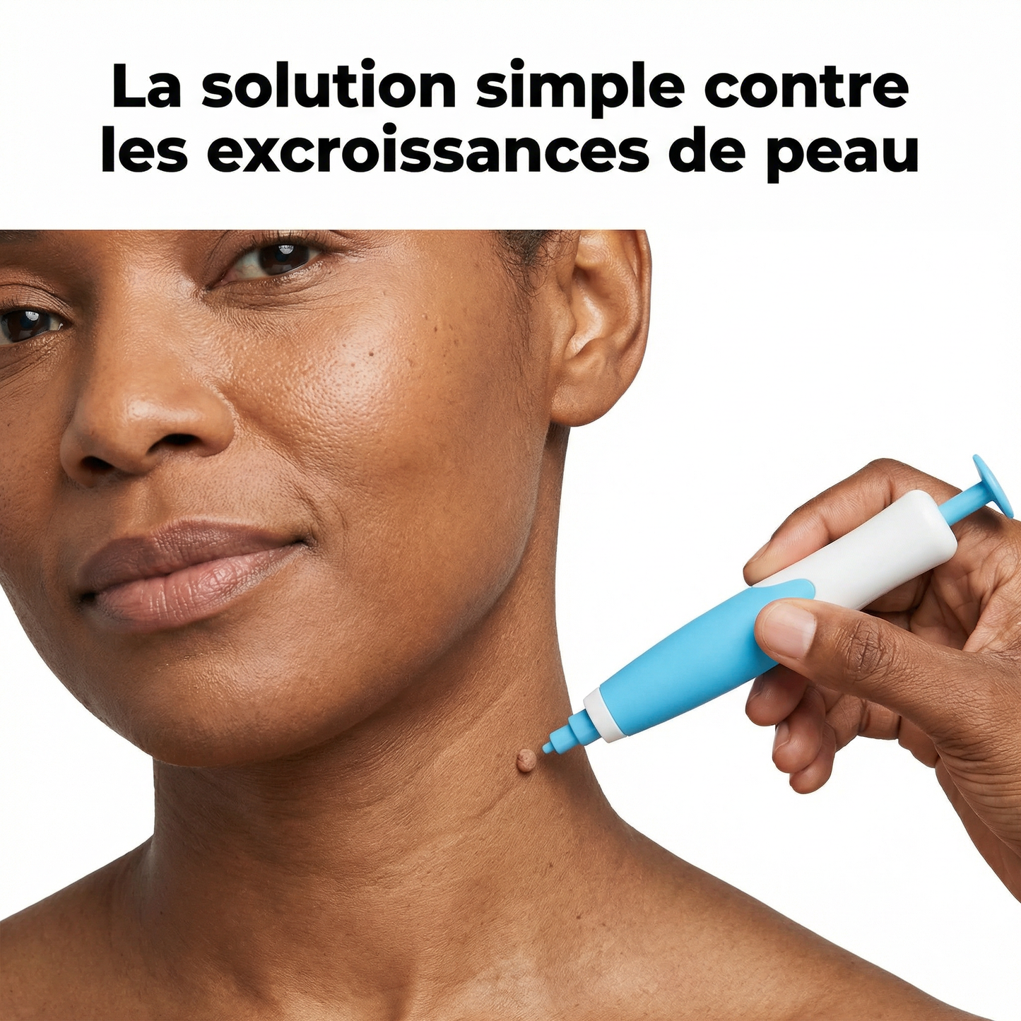 Kit Skin Tag – Éliminez les excroissances de peau à la maison
