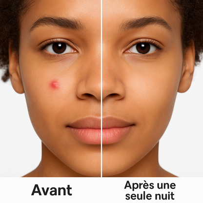 Patch Anti-Acné Invisible - Dites adieu à vos boutons