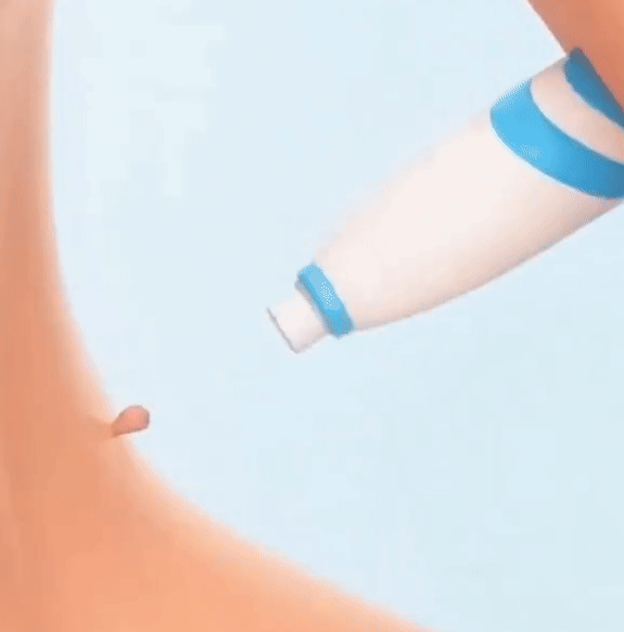 Kit Skin Tag – Éliminez les excroissances de peau à la maison